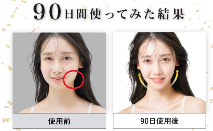 顔のたるみ改善